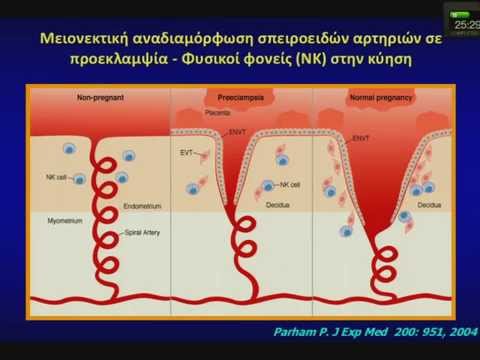 Βίντεο: Πότε εμφανίζεται διάχυτη ενδαγγειακή πήξη;