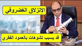 الإنزلاق الغضروفي القطني قد يسبب تشوهات بالعمود الفقري و علاج التشوة هو علاج الإنزلاق الغضروفي