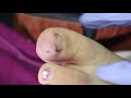 Ep_1895 Big ingrown toenail removal 👣 อือหือ..สาวสวย 😷  (This clip is from Thailand)