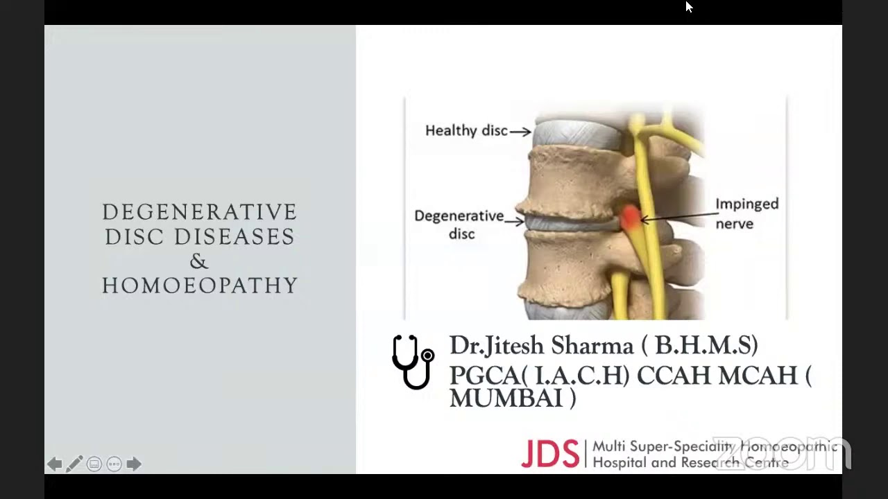Degenerative Disc Diseases & Homoeopathy YouTube