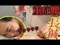【吸い玉　悶絶整体】20代女子スタッフの瘀血が酷すぎ　腰の奥は長い鍼でガッツリ治療　20cmの鍼は... 　自宅でできるツボ法も教えます。【横浜元町　東京銀座　鍼灸】