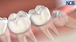 Post-Op Instructions: Wisdom Teeth at Naperville Oral Surgery & Dental Implants