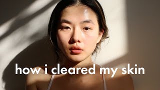 HOW I GOT RID OF ACNE, TEXTURED SKIN unsponsored skincare routine + diet