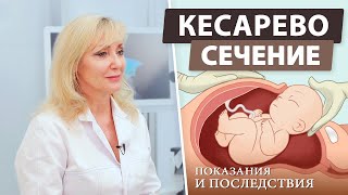 Кесарево сечение — что такое и когда назначается?