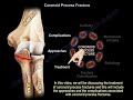 Coronoid Process Fracture Treatment ,approaches   Everything You Need To Know - Dr. Nabil Ebraheim