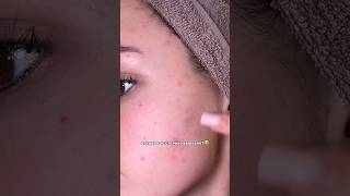 мое ДО потом покажу результат подписывайся УЗ прыщи лечениепрыщей