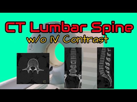 CT Lumbar Spine without IV Contrast