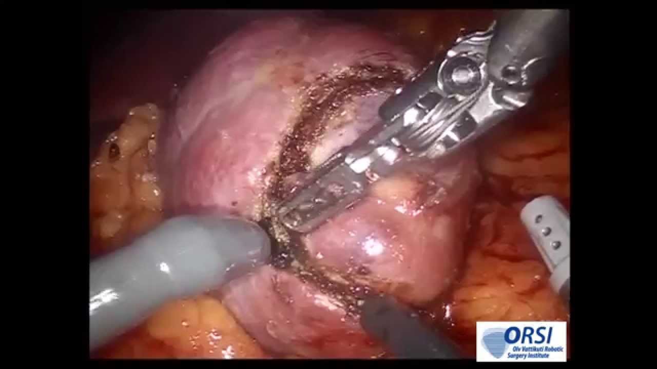 Concurrent Management Of Bilateral Ureteropelvic Junction