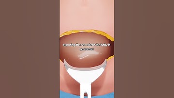 How A C-Section Is Performed #foryou #shortvideo #shorts #youtubeshorts #csetion #short