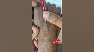 intravenous injection procedure 💉 | #viralshorts #trendingshorts #shorts #injection