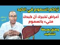 تراكم السموم بالكبد علامات خطيرة وطرق بسيطة للتنظيف 