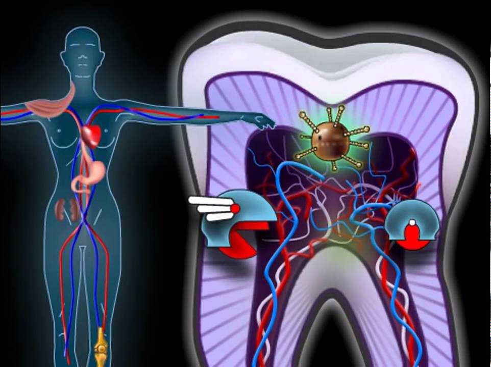 Опасное заболевание зуба - пульпит.