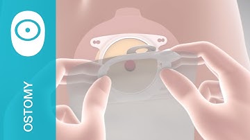 How to apply SenSura Mio with click application – instructional video, point of view of nurse