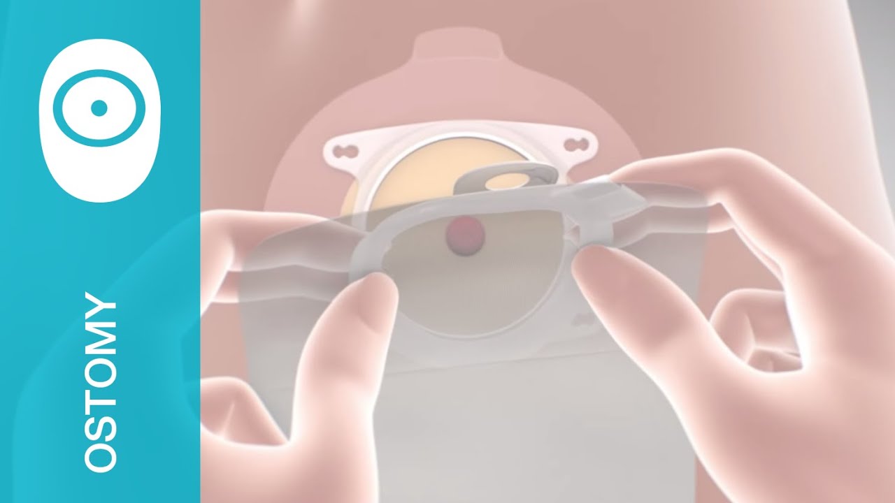 18305 Coloplast SenSura Mio Flip Ileostomy Pouches | The Parthenon