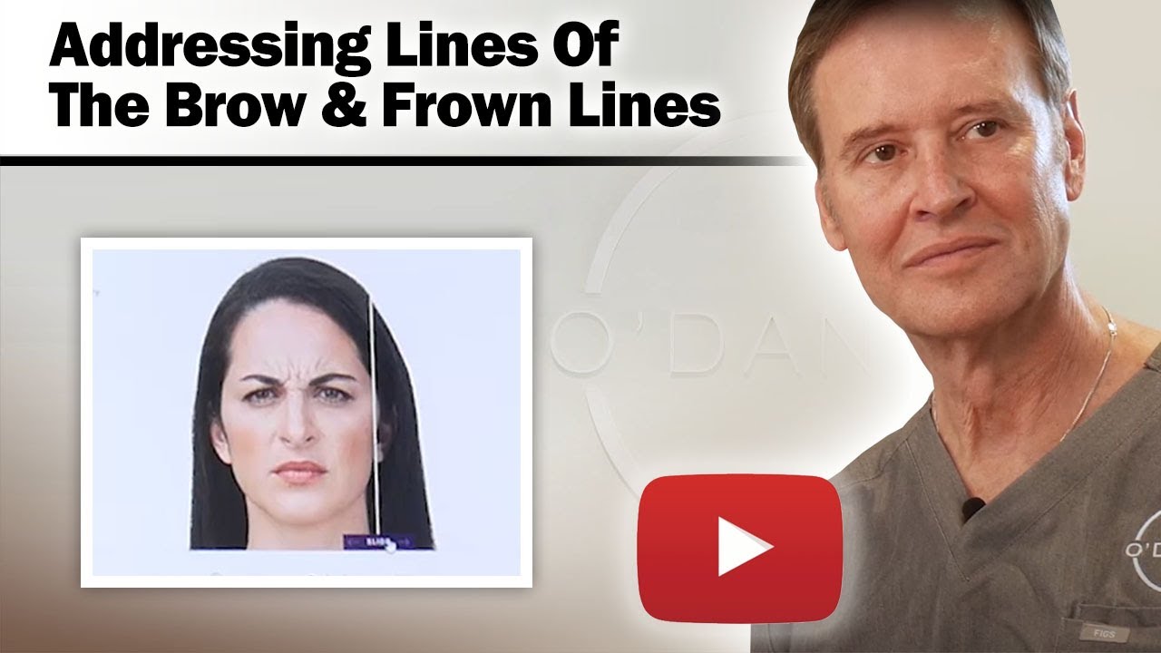 BOTOX - Addressing Lines Of The Brow And Frown Lines