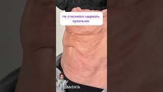Подтяжка кожи без операции #косметологмосква