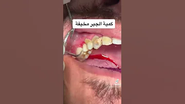 تنظيف جير الاسنان المخيف بالامواج فوق الصوتية خلال ٥ دقائق 