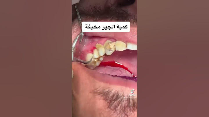تنظيف جير الاسنان المخيف بالامواج فوق الصوتية خلال ٥ دقائق