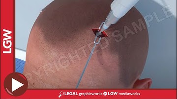 TBI car accident Diffuse Axonal Injury 3D animation