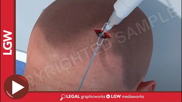 TBI car accident Diffuse Axonal Injury 3D animation