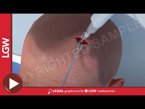 TBI car accident Diffuse Axonal Injury 3B animation