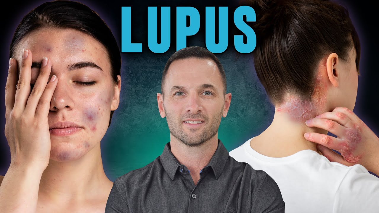 ¿Morados en la piel? ATENCIÓN 🚨 Son SINTOMAS de LUPUS