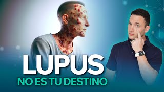 ¿Morados en la piel? ATENCIÓN  puede ser LUPUS