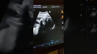 Ultrasound 26weeks preggy || all about baby shaine