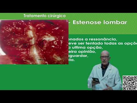 Vídeo: A espondilose lombossacral é uma deficiência?