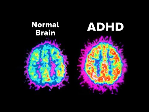 Why Does Your ADHD Make Things So Hard?