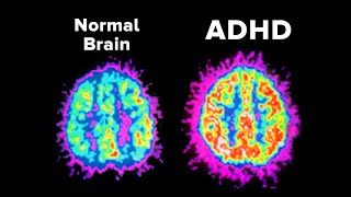 Why Does Your ADHD Make Things So Hard?