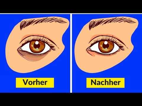 Video: Wie Unter Augenringen Loswerden? 3 Effektive Methoden