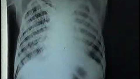 17 Ke Tom Tat[bacsihoasung.wordpress.com].wmv