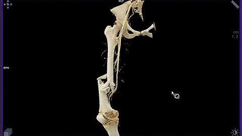 Femur Fx with CTA with Cinematic Rendering