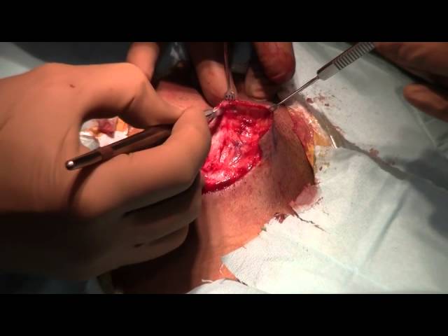 M-Plasty Scar Revision with Dr. Miller
