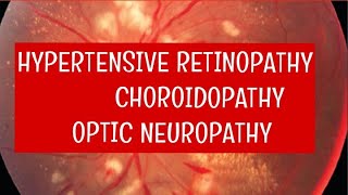 HYPERTENSIVE RETINOPATHY || pathology and signs