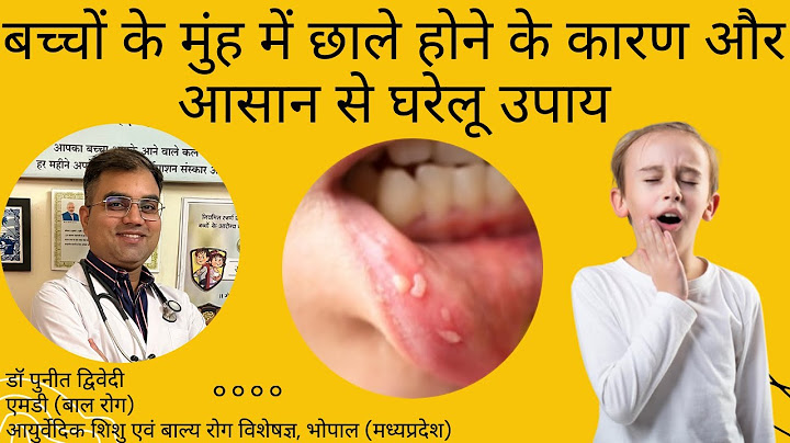 बच्चों के मुँह और जीभ के छाले केवल 2 दिन में ठीक करे । डॉ पुनीत द्विवेदी