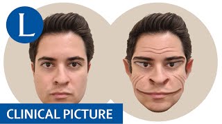 Visualising facial distortions in prosopometamorphopsia