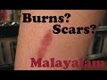 How to Treat Burns and Scars - Malayalam