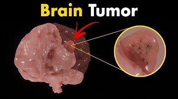 Brain tumors (Gliomas) | Symptoms, Diagnosis & Treatments