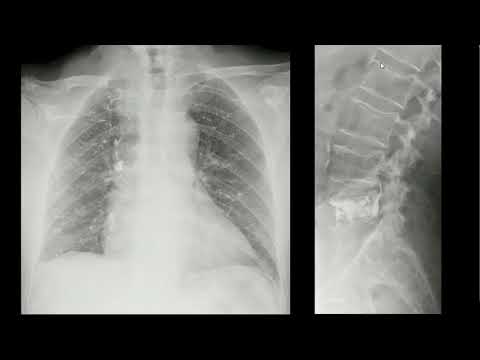 Vídeo: A radiografia de tórax mostrará uma embolia pulmonar?