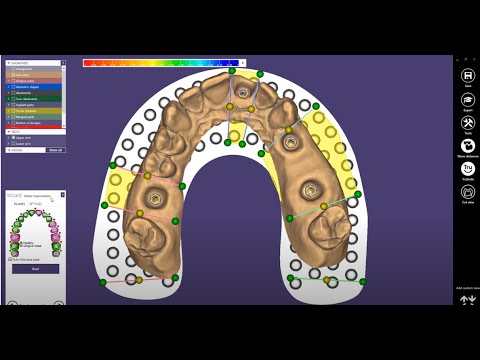 REDDENTAL exocad Quick Guide  Implant Model