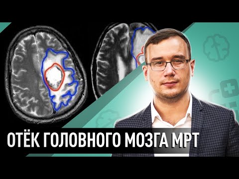 Отёк головного мозга, МРТ диагностика