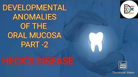 ( " HECKS DISEASE ") - DEVELOPMENTAL ANAMOLIES OF THE ORAL MUCOSA PART-2