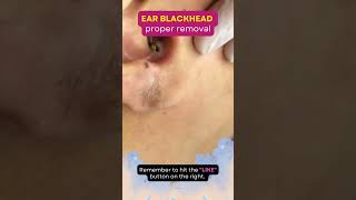 Removing MONSTER Blackhead in Ear!  #shorts