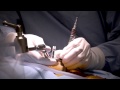 Minimally Invasive Laminectomy Surgery to Treat Lumbar Stenosis - MedStar Southern Maryland