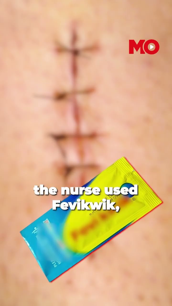 Shocking Negligence: Nurse Glues Child’s Wound with Fevi Kwik