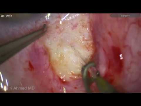 Nanophthalmos Angle Closure Glaucoma Surgery