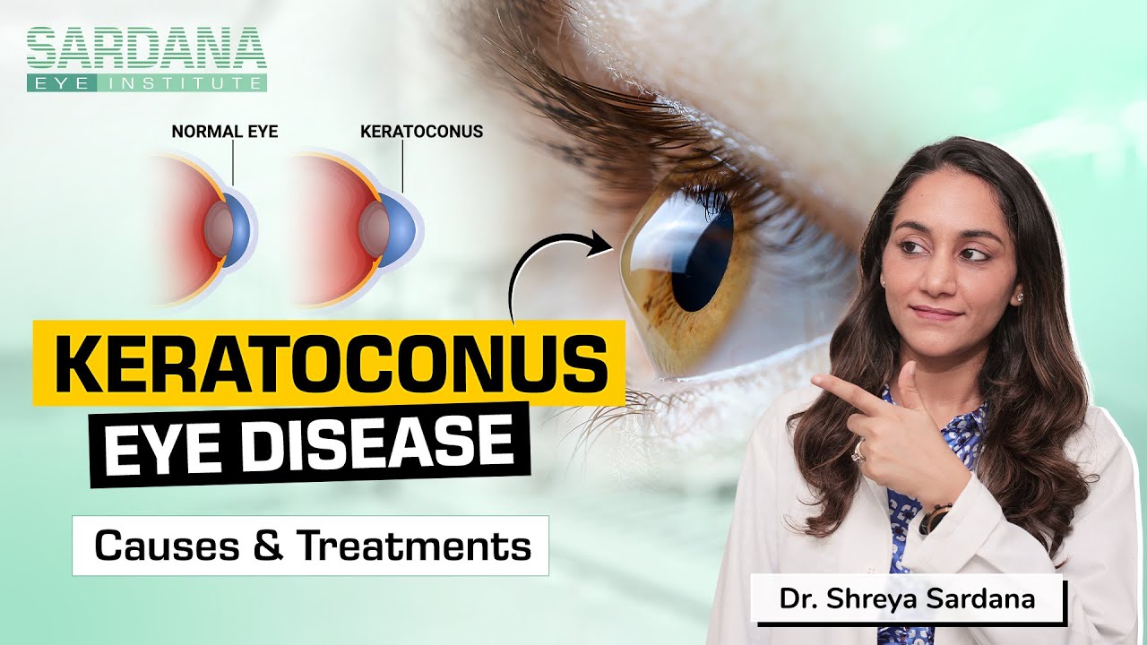 Keratoconus Eye Disease Best Eye Doctor in Delhi Dr. Shreya Sardana YouTube