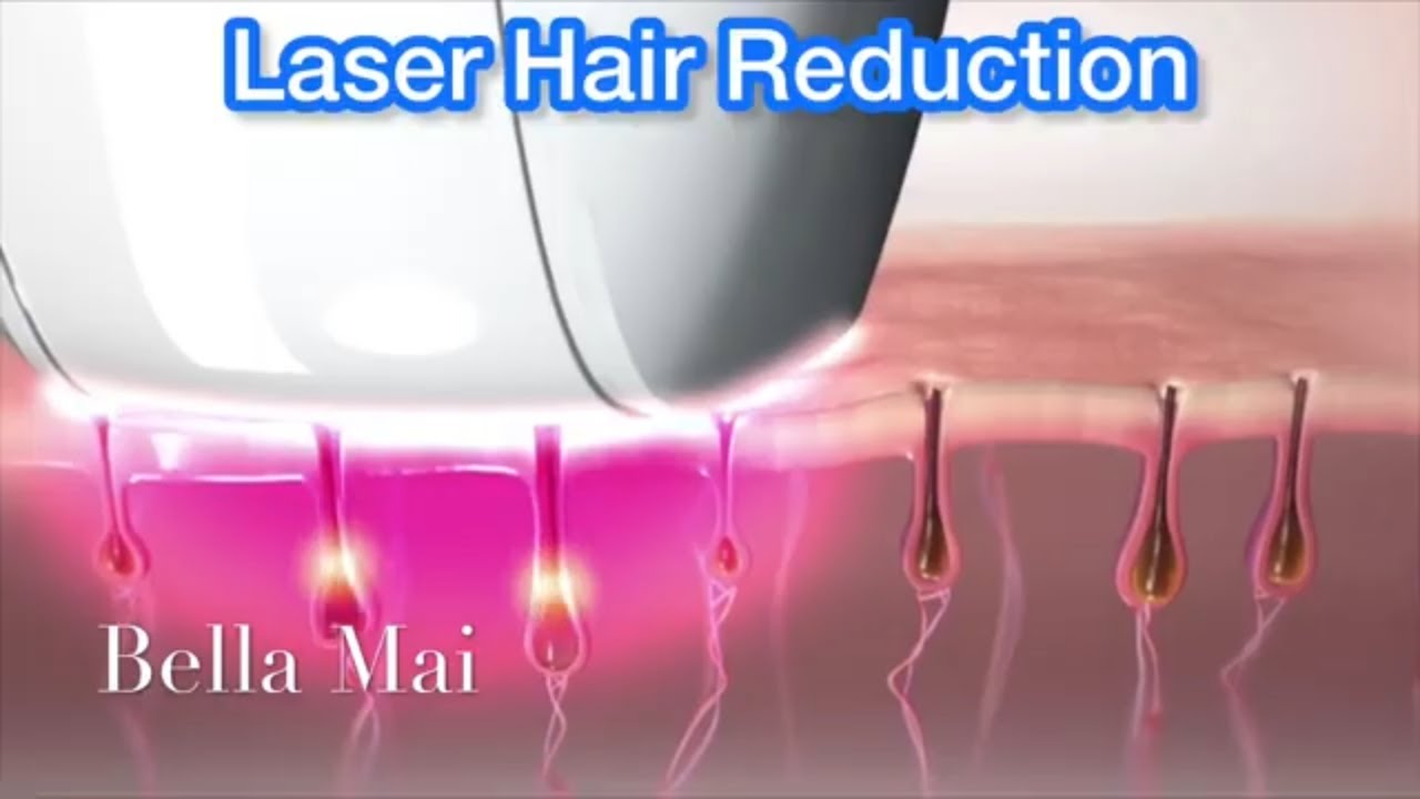 IPL/SHR/DIODE Laser Hair Removal